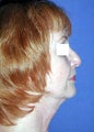 Neck Lift Surgery