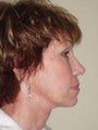 Neck Lift Surgery