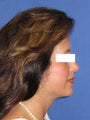 Neck Lift Surgery