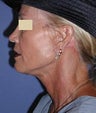 Neck Lift Surgery