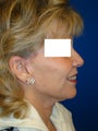 Neck Lift Surgery