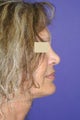 Neck sling procedure