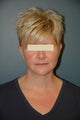 Neck lift