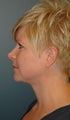 Neck lift