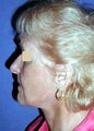 Face and Neck Lift Surgery