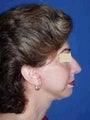 Face and Neck Lift Surgery