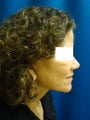 Neck and Face Lift Surgery