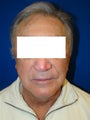 Face and Neck Lift