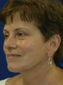 Lower Facelift and Necklift with Platysmaplasty 