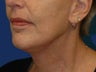 Lower Facelift and Necklift with Platysmaplasty 