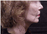 Neck Lift