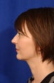 Necklace procedure with anatomic chin implant