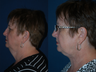 Neck Lift