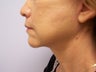 Face and Neck Lift