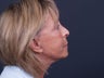Neck Lift