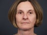 61 year old female with facial aging.