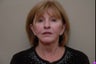 58 year old female seeking surgery for facial and neck rejuvenation, laxity of skin, peri-oral smokers lines 