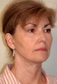 Neck Lift