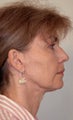 Before and After Neck Lift (Side View)