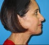Limited Incision Neck Lift