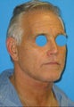 Limited incision neck lift