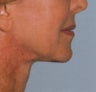 Neck Lift