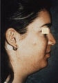 Chin Implant/Necklift/MiniLipo