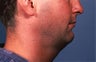 Necklift 