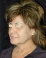 Facelift / Necklift 