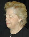 Facelift / Necklift 