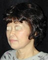 Facelift / Necklift 