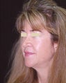 Facelift / Necklift 