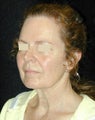Facelift / Necklift 