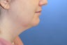 Neck Lift