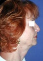 Neck Lift Surgery