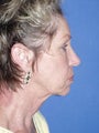 Neck Lift Surgery