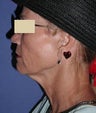 Neck Lift Surgery