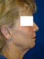Neck Lift Surgery