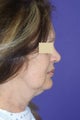 Neck sling procedure