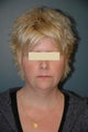 Neck lift