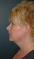 Neck lift