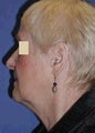 Face and Neck Lift Surgery