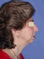 Face and Neck Lift Surgery