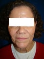 Neck and Face Lift Surgery
