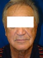 Face and Neck Lift