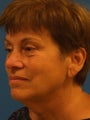 Lower Facelift and Necklift with Platysmaplasty 