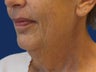 Lower Facelift and Necklift with Platysmaplasty 