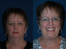 Neck Lift