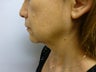 Face and Neck Lift