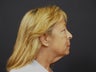 Neck Lift